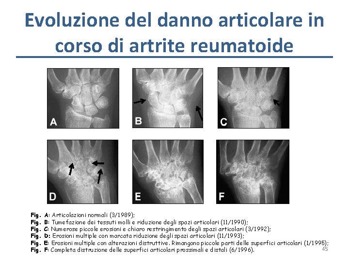 Evoluzione del danno articolare in corso di artrite reumatoide Fig. A: Articolazioni normali (3/1989);