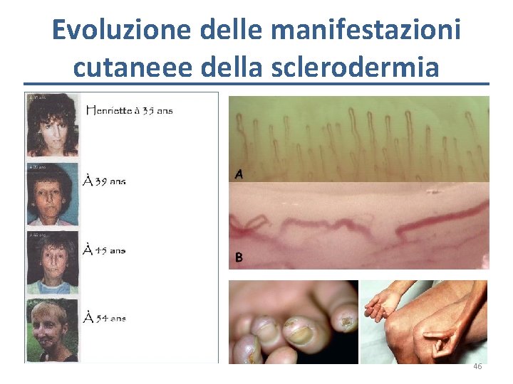 Evoluzione delle manifestazioni cutaneee della sclerodermia 46 