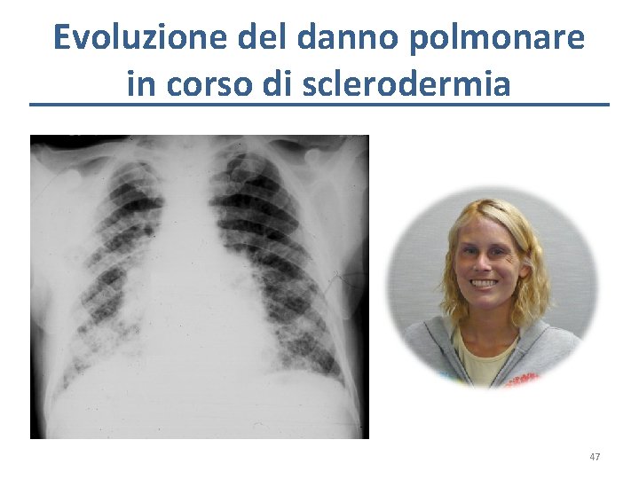 Evoluzione del danno polmonare in corso di sclerodermia 47 