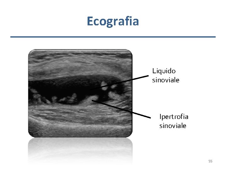 Ecografia Liquido sinoviale Ipertrofia sinoviale 55 