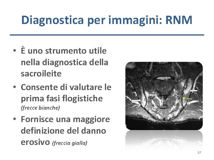 Diagnostica per immagini: RNM • È uno strumento utile nella diagnostica della sacroileite •