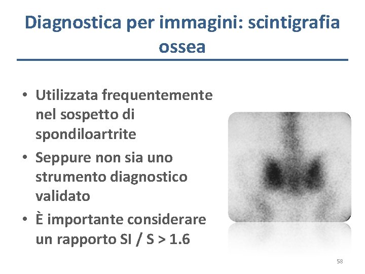 Diagnostica per immagini: scintigrafia ossea • Utilizzata frequentemente nel sospetto di spondiloartrite • Seppure