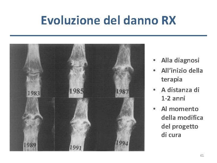 Evoluzione del danno RX • Alla diagnosi • All’inizio della terapia • A distanza