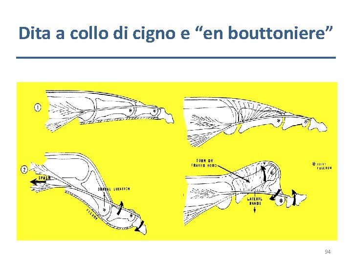 Dita a collo di cigno e “en bouttoniere” 94 