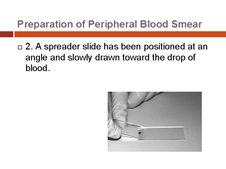 Preparation of Peripheral Blood Smear 2. A spreader slide has been positioned at an
