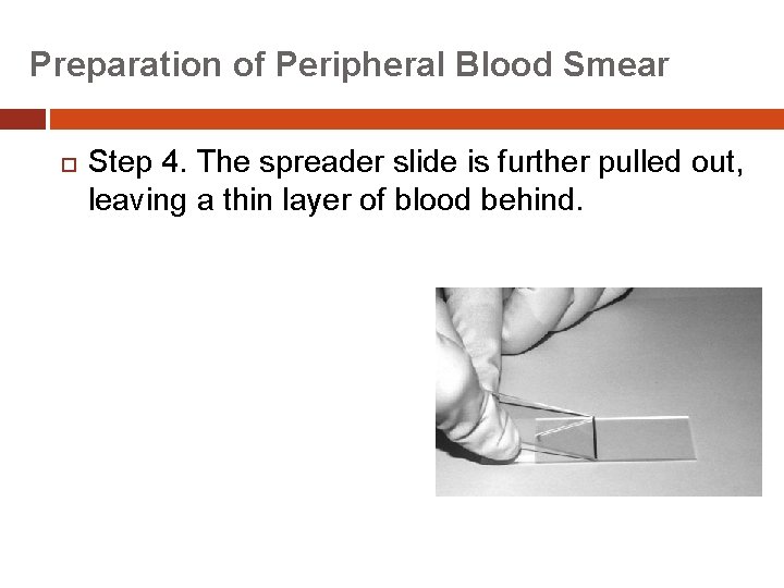 Preparation of Peripheral Blood Smear Step 4. The spreader slide is further pulled out,