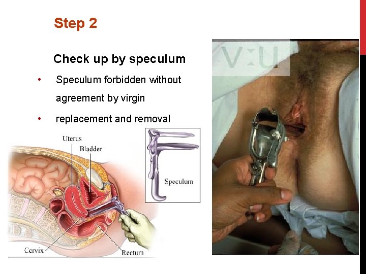 Step 2 Check up by speculum • Speculum forbidden without agreement by virgin •