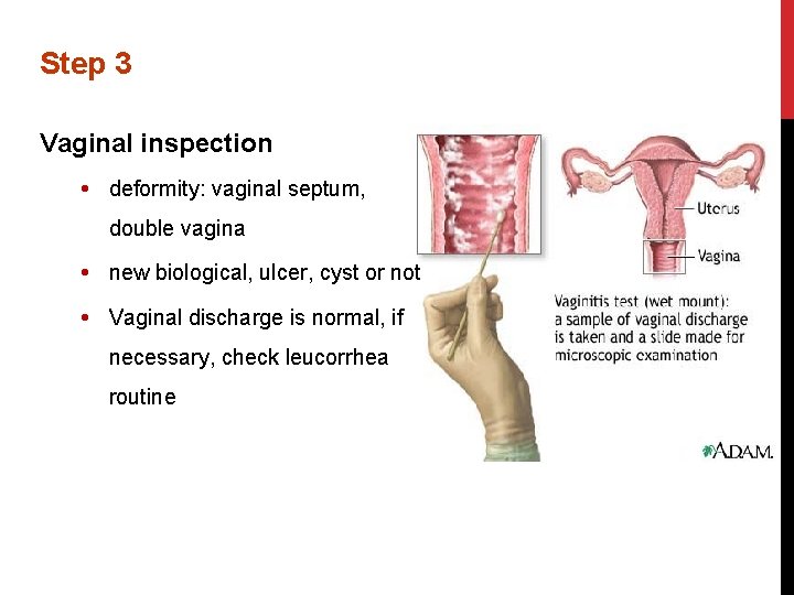 Step 3 Vaginal inspection deformity: vaginal septum, double vagina new biological, ulcer, cyst or