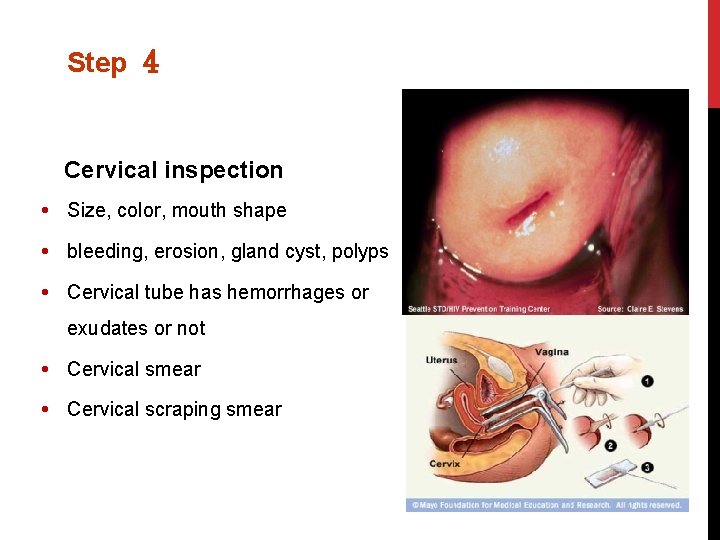 Step 4 Cervical inspection Size, color, mouth shape bleeding, erosion, gland cyst, polyps Cervical