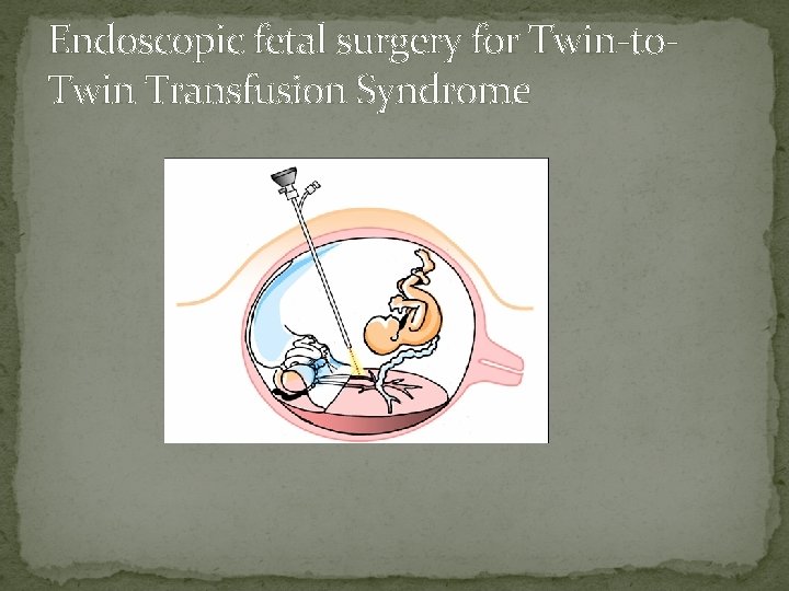 Endoscopic fetal surgery for Twin-to. Twin Transfusion Syndrome 