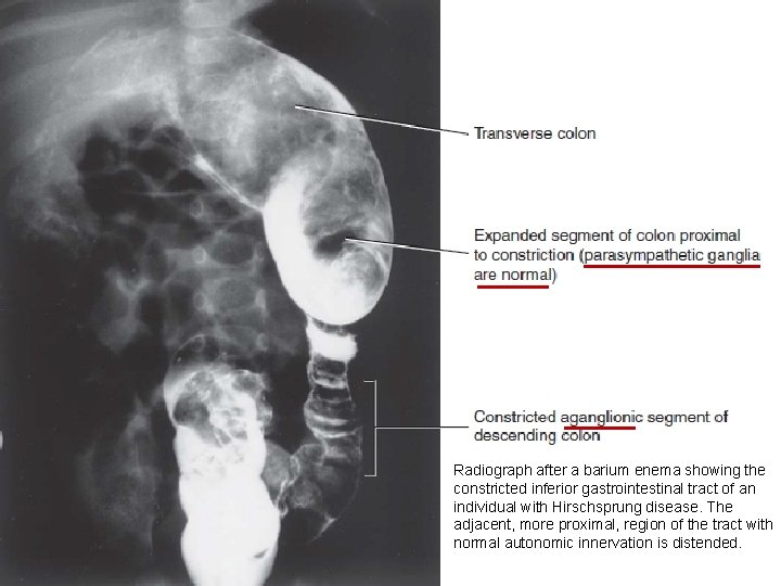 Radiograph after a barium enema showing the constricted inferior gastrointestinal tract of an individual