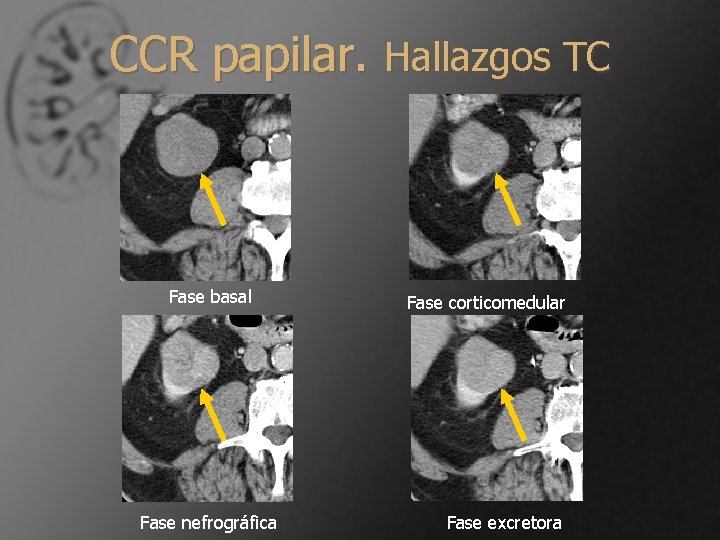 CCR papilar. Hallazgos TC Fase basal Fase nefrográfica Fase corticomedular Fase excretora 