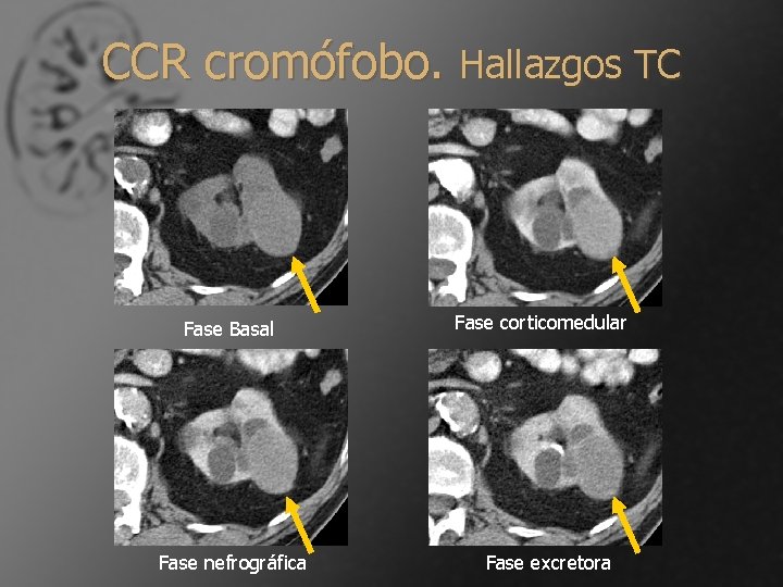 CCR cromófobo. Hallazgos TC Fase Basal Fase nefrográfica Fase corticomedular Fase excretora 