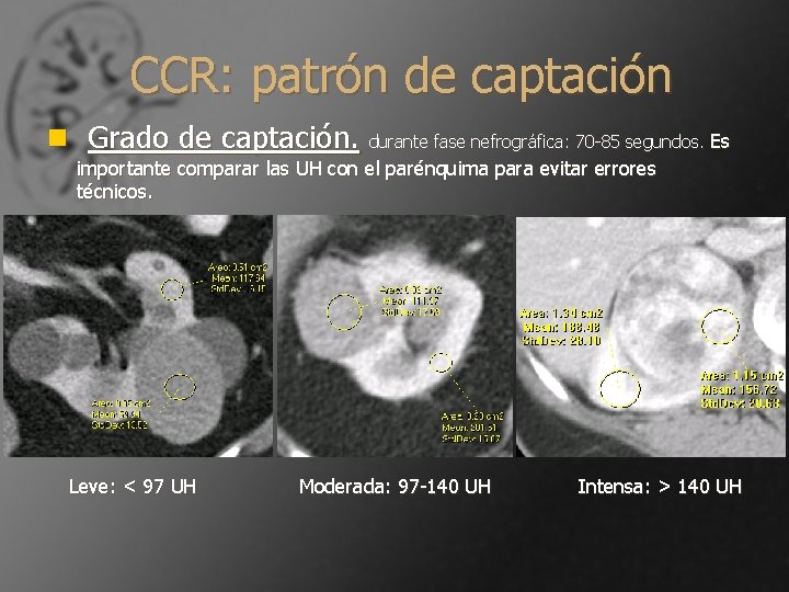 CCR: patrón de captación n Grado de captación. durante fase nefrográfica: 70 -85 segundos.