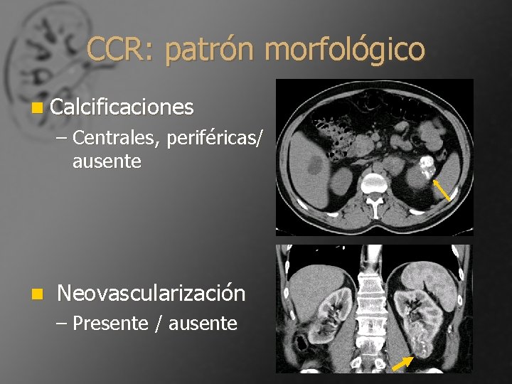 CCR: patrón morfológico n Calcificaciones – Centrales, periféricas/ ausente n Neovascularización – Presente /