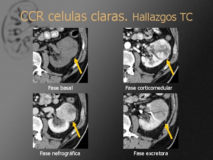 CCR celulas claras. Hallazgos TC Fase basal Fase nefrográfica Fase corticomedular Fase excretora 