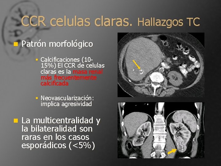 CCR celulas claras. Hallazgos TC n Patrón morfológico § Calcificaciones (1015%) El CCR de