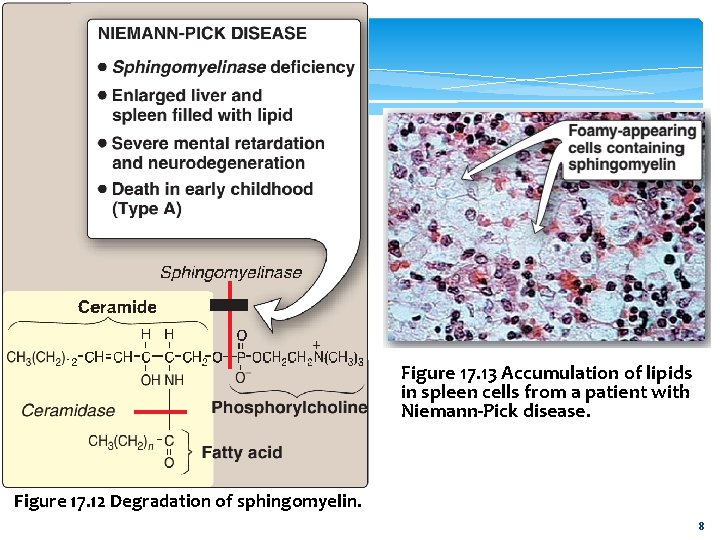 Figure 17. 13 Accumulation of lipids in spleen cells from a patient with Niemann-Pick