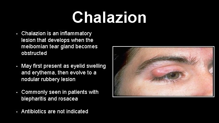 Chalazion • Chalazion is an inflammatory lesion that develops when the meibomian tear gland