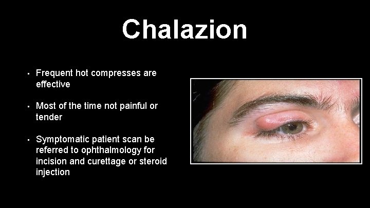 Chalazion • Frequent hot compresses are effective • Most of the time not painful