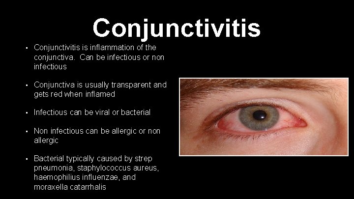 Conjunctivitis • Conjunctivitis is inflammation of the conjunctiva. Can be infectious or non infectious