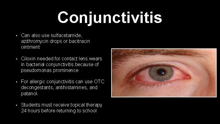 Conjunctivitis • Can also use sulfacetamide, azithromycin drops or bacitracin ointment • Ciloxin needed