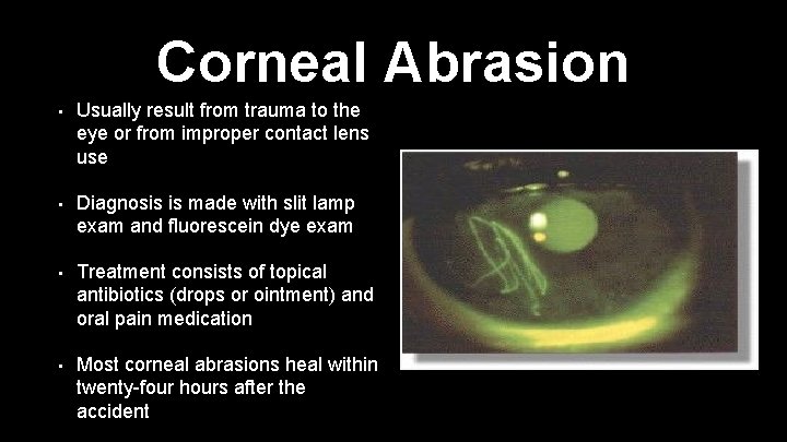 Corneal Abrasion • Usually result from trauma to the eye or from improper contact