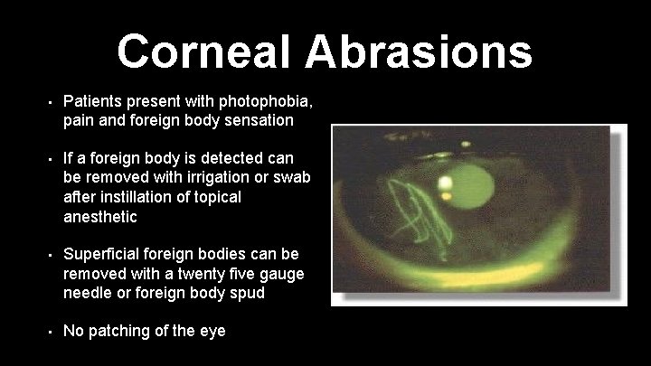 Corneal Abrasions • Patients present with photophobia, pain and foreign body sensation • If