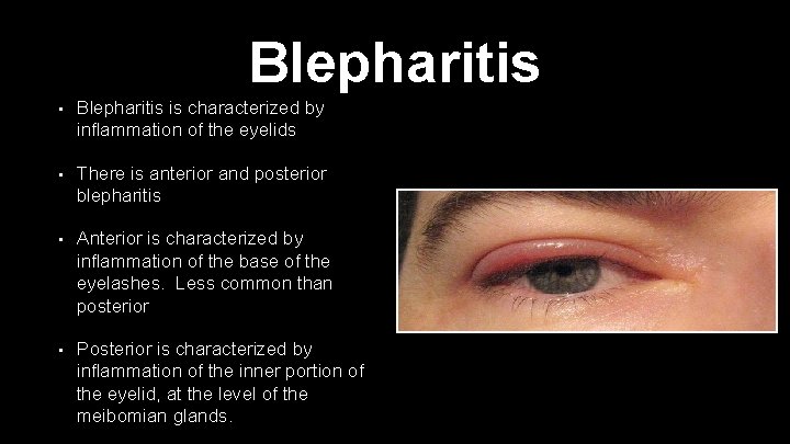 Blepharitis • Blepharitis is characterized by inflammation of the eyelids • There is anterior
