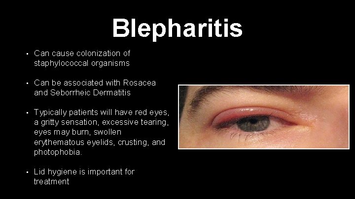 Blepharitis • Can cause colonization of staphylococcal organisms • Can be associated with Rosacea