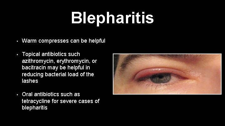 Blepharitis • Warm compresses can be helpful • Topical antibiotics such azithromycin, erythromycin, or