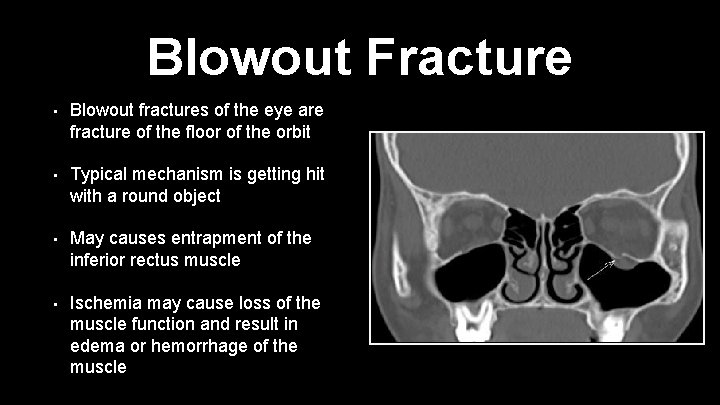 Blowout Fracture • Blowout fractures of the eye are fracture of the floor of