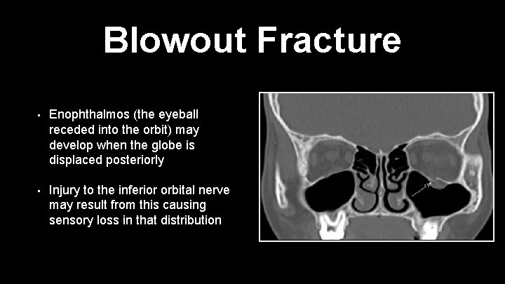 Blowout Fracture • Enophthalmos (the eyeball receded into the orbit) may develop when the