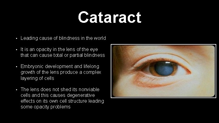 Cataract • Leading cause of blindness in the world • It is an opacity