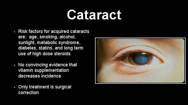Cataract • Risk factors for acquired cataracts are: age, smoking, alcohol, sunlight, metabolic syndrome,