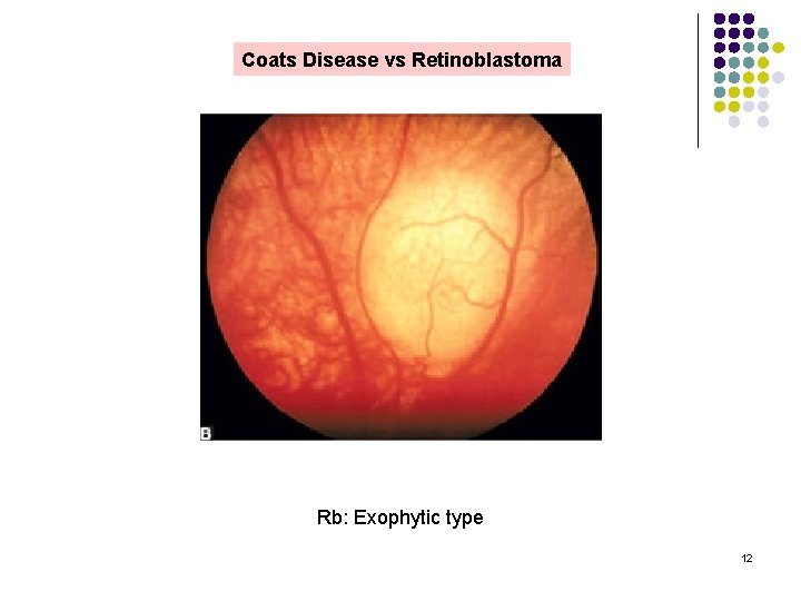 Coats Disease vs Retinoblastoma Rb: Exophytic type 12 