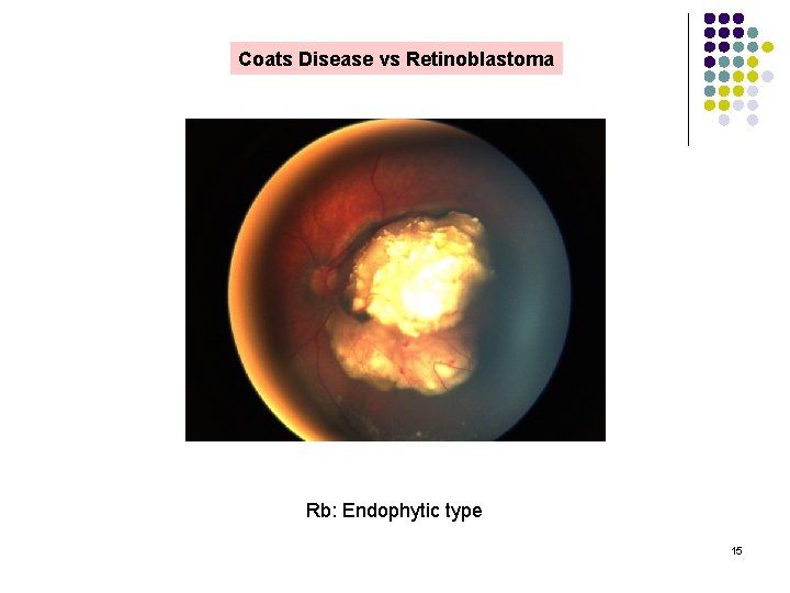 Coats Disease vs Retinoblastoma Rb: Endophytic type 15 