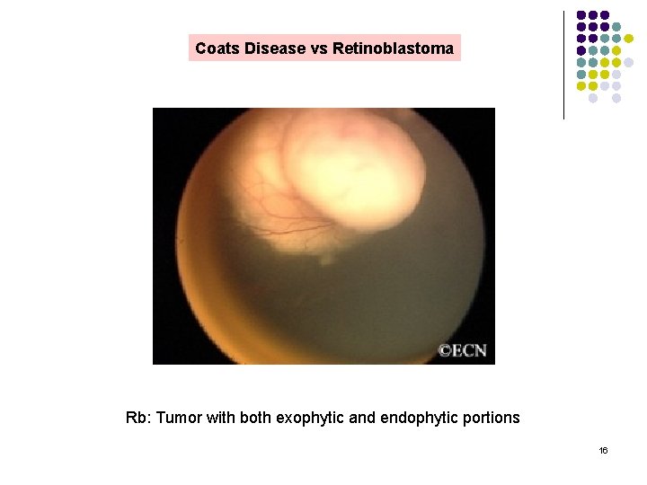 Coats Disease vs Retinoblastoma Rb: Tumor with both exophytic and endophytic portions 16 