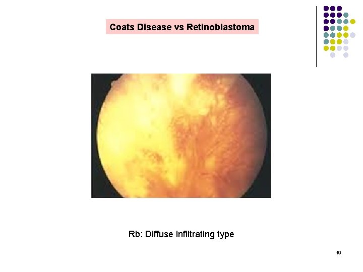 Coats Disease vs Retinoblastoma Rb: Diffuse infiltrating type 19 