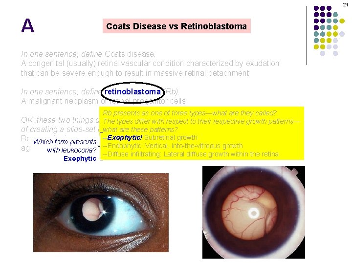 21 A Coats Disease vs Retinoblastoma In one sentence, define Coats disease. A congenital