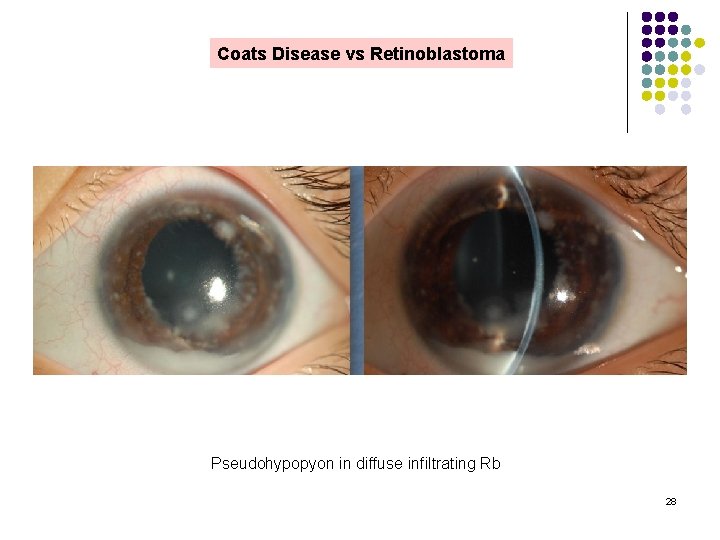Coats Disease vs Retinoblastoma Pseudohypopyon in diffuse infiltrating Rb 28 