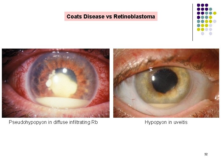 Coats Disease vs Retinoblastoma Pseudohypopyon in diffuse infiltrating Rb Hypopyon in uveitis 32 