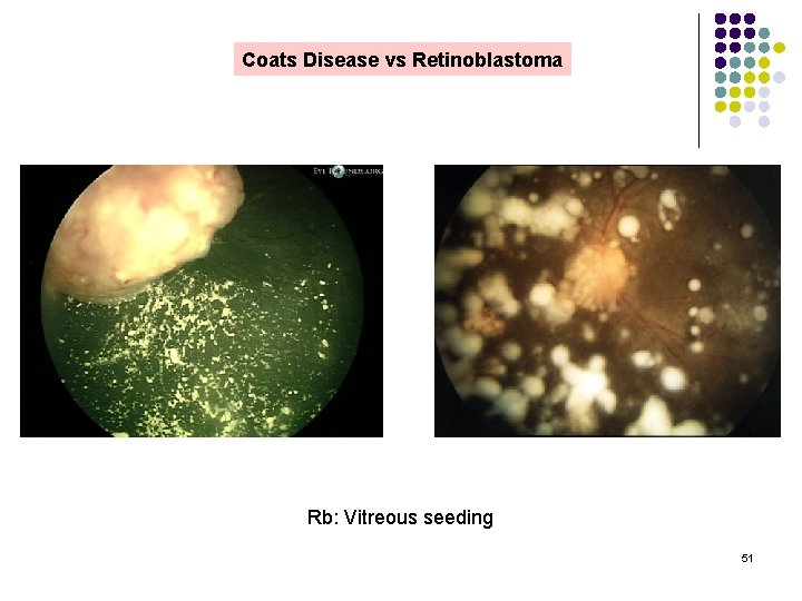 Coats Disease vs Retinoblastoma Rb: Vitreous seeding 51 