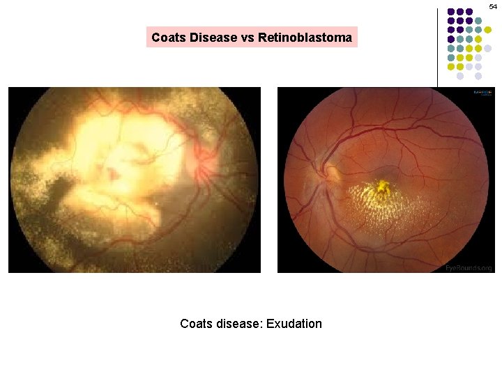 54 Coats Disease vs Retinoblastoma Coats disease: Exudation 