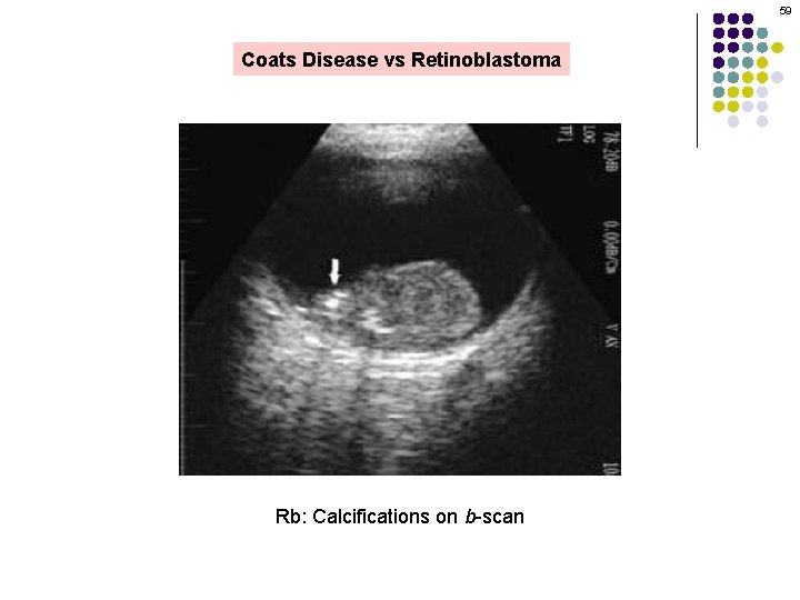 59 Coats Disease vs Retinoblastoma Rb: Calcifications on b-scan 