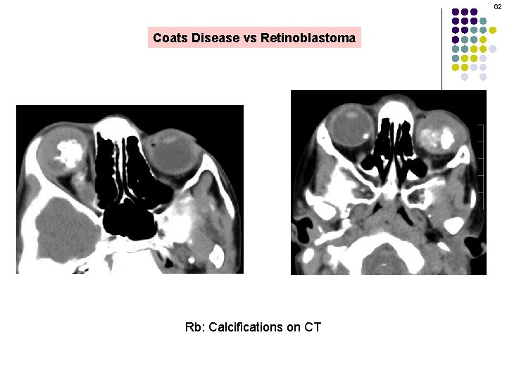 62 Coats Disease vs Retinoblastoma Rb: Calcifications on CT 