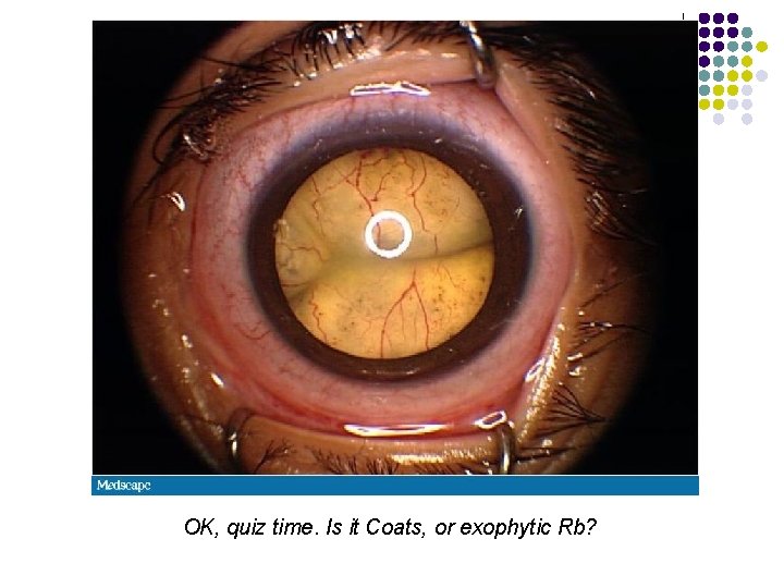 OK, quiz time. Is it Coats, or exophytic Rb? 