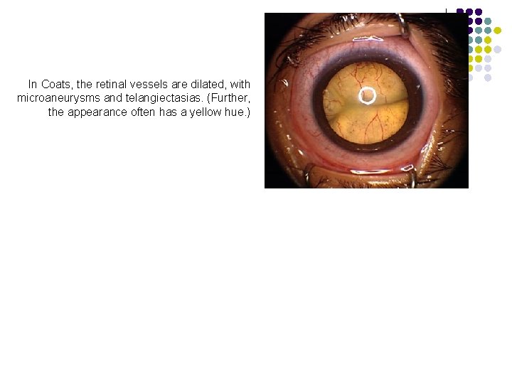 In Coats, the retinal vessels are dilated, with microaneurysms and telangiectasias. (Further, the appearance