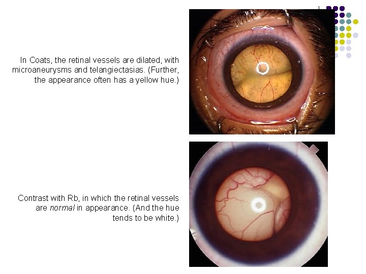 In Coats, the retinal vessels are dilated, with microaneurysms and telangiectasias. (Further, the appearance