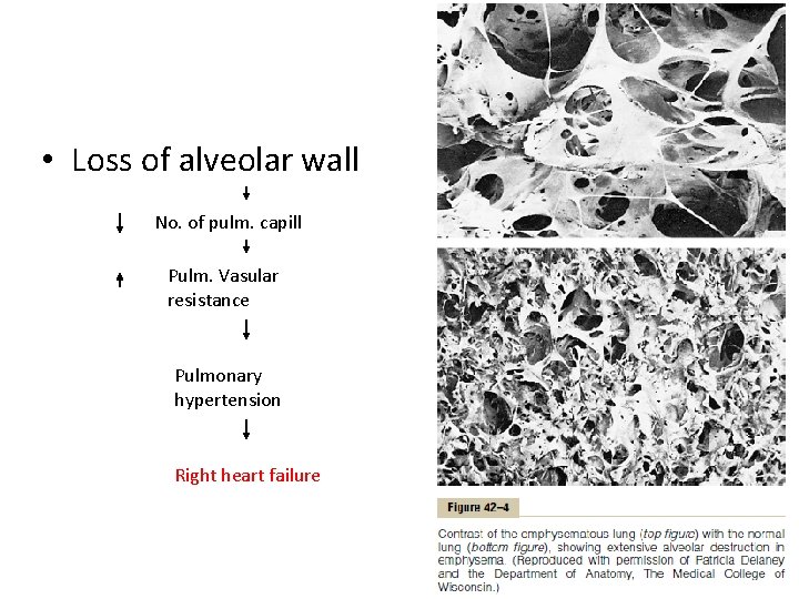  • Loss of alveolar wall No. of pulm. capill Pulm. Vasular resistance Pulmonary